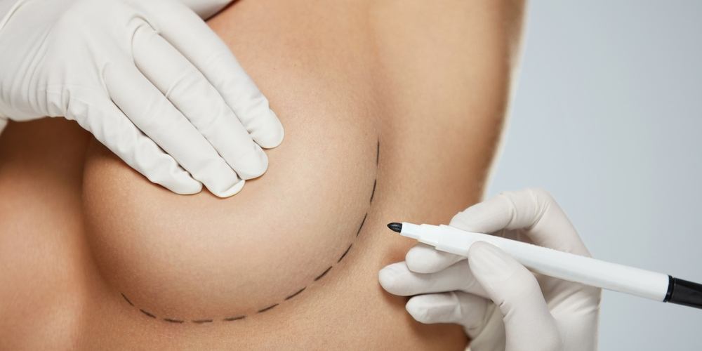 Breast Augmentation Surgery