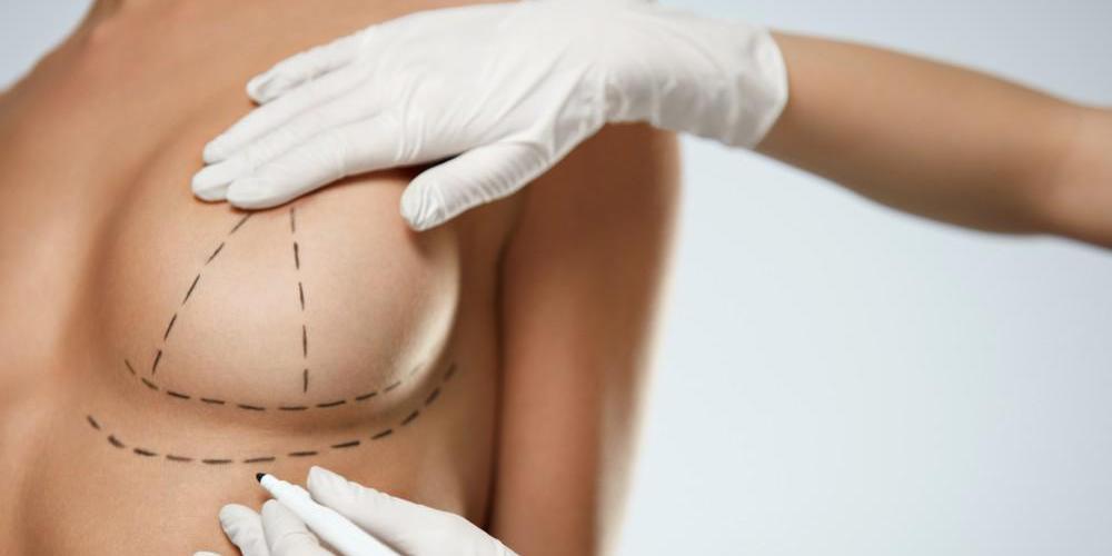 Surgery for Sagging Breast